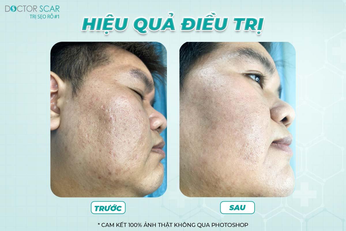 Hiệu quả trước và sau điều trị sẹo rỗ tại Doctor Scar