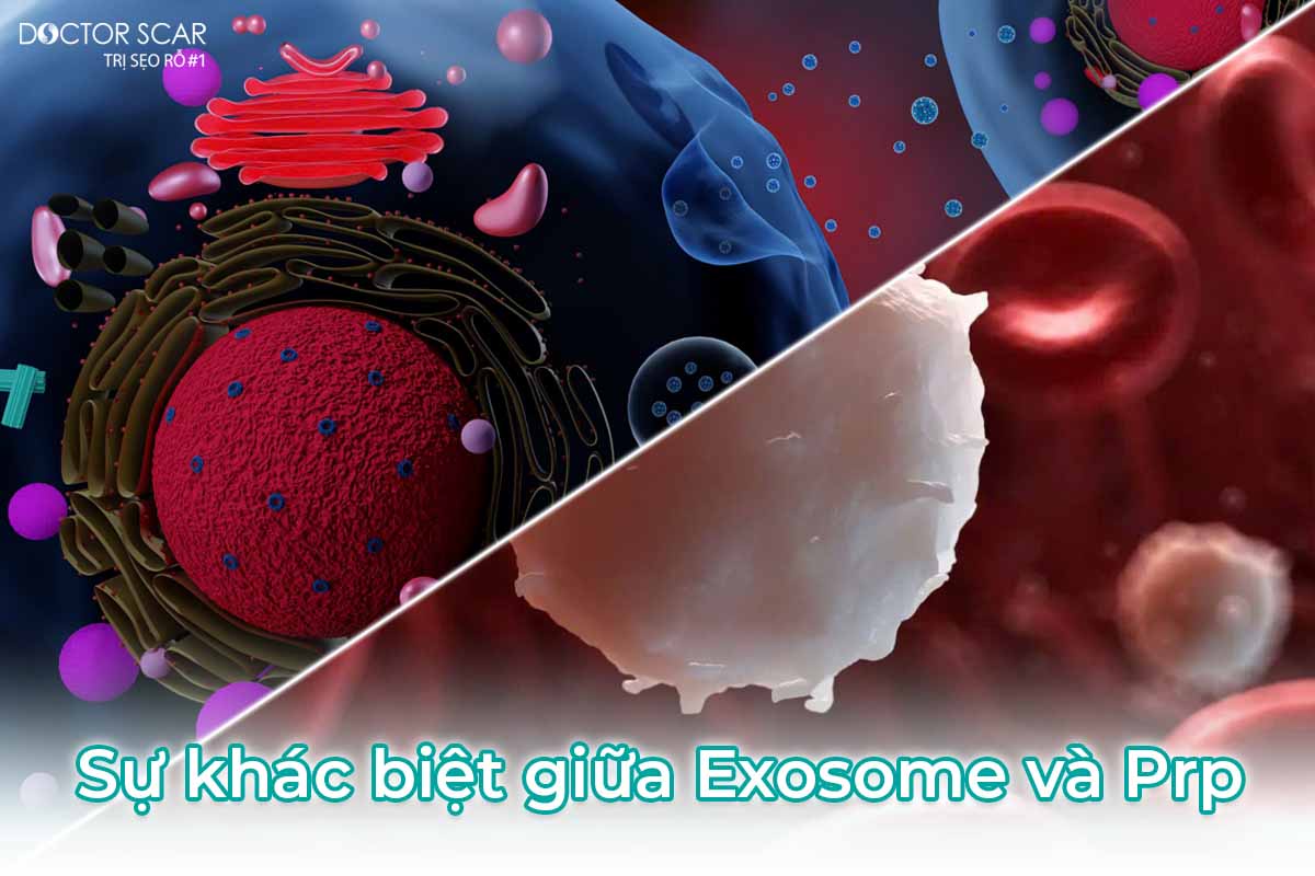 Sự khác nhau giữa tiêm exosome và tiêm prp