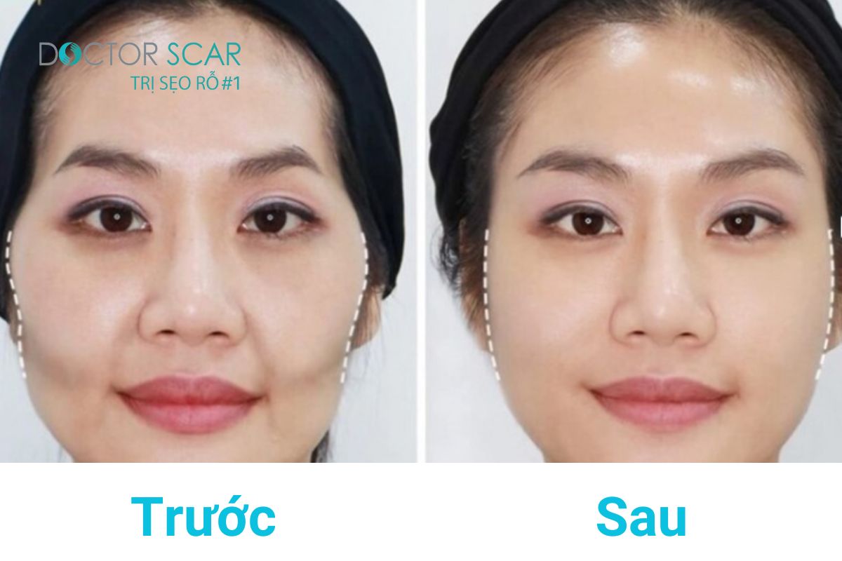 Tiêm Filler có hại không? Có bầu tiêm Filler được không? Cho con bú có tiêm được Filler không? Có tác dụng phụ không? Tiêm filler bao lâu thì hết sưng?