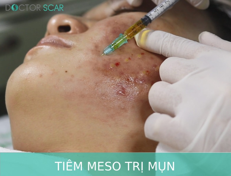 Tiêm meso trị mụn