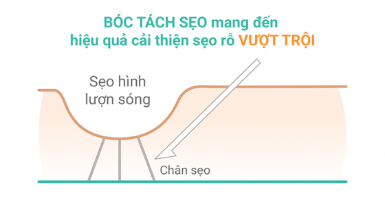 Subcision là gì và có tác dụng gì trong điều trị sẹo rỗ? 
