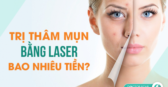 Laser Q-Switched là gì và nó làm thế nào để trị thâm mụn?
