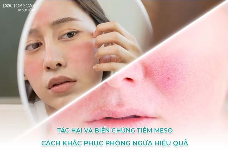 Một số tác hại của tiêm meso thường gặp không nên chủ quan